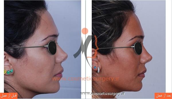 ترمیم بینی در بیماری که قبلا توسط جراحان دیگری عمل شده است