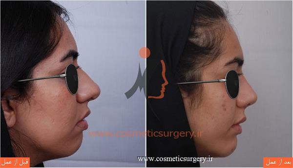 عمل جراحی بینی گوشتی به همراه جراحی چانه