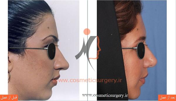 Broiler nose surgery9