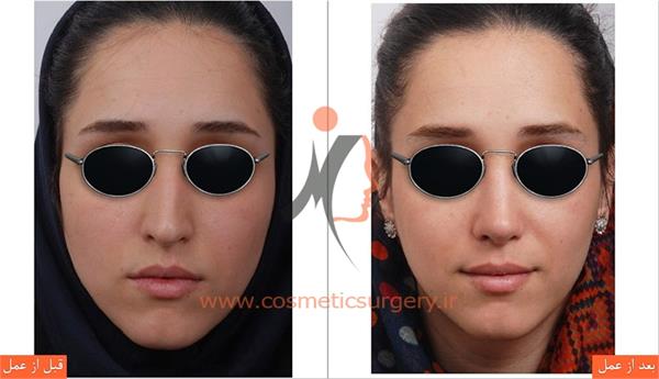 جراحی زیبایی بینی