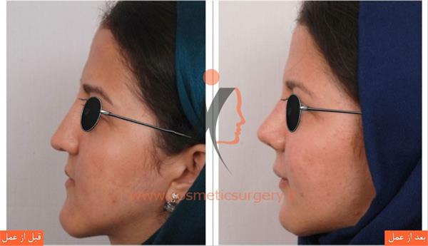 ترمیم بینی عمل شده توسط جراحان دیگر به همراه تزریق چربی و جراحی فک