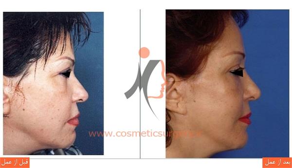 لیفت کامل صورت به همراه جوان سازی دور چشم