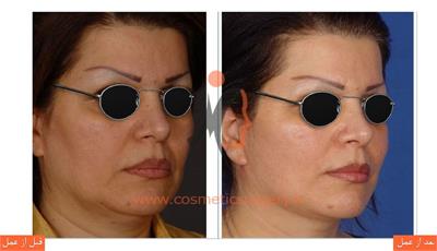 لیفت صورت به همراه لیفت گردن