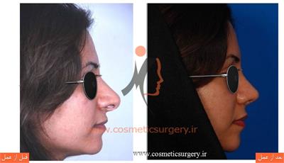 ترمیم بینی در بیماری که قبلا توسط جراحان دیگری عمل شده است