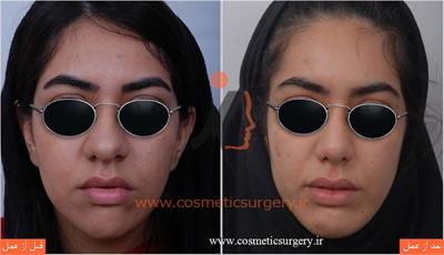 عمل جراحی بینی گوشتی به همراه جراحی چانه