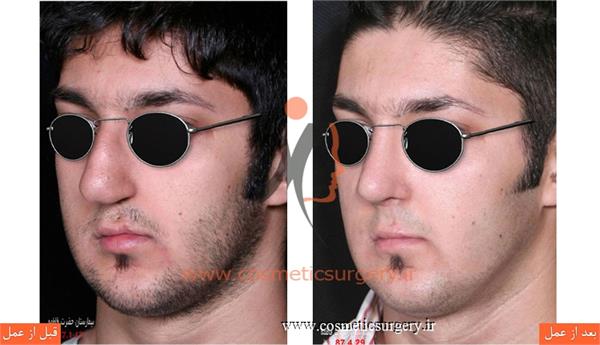 جراحی زیبایی بینی به همراه ترمیم شکاف لب و کام