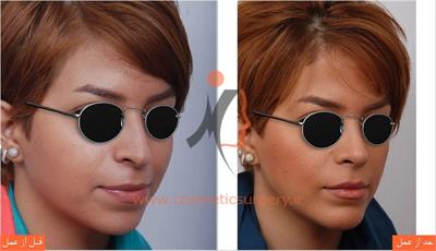 جراحی زیبایی بینی و جراحی چانه