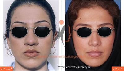 Broiler nose surgery8
