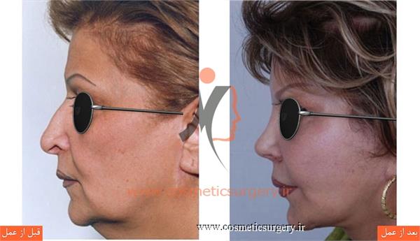 ترمیم بینی عمل شده توسط جراحان دیگر به همراه لیفت صورت و گردن ثانویه و تزریق چربی (صورت و گردن بیمار یک بار توسط جراح دیگر لیفت شده است)