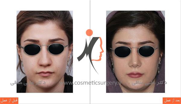 عمل جراحی زیبایی بینی گوشتی 1