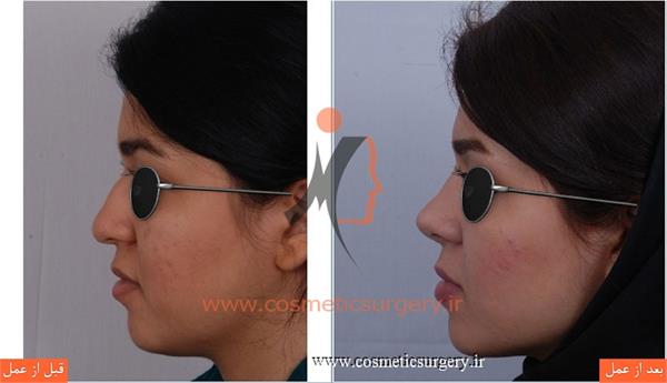 جراحی زیبایی بینی