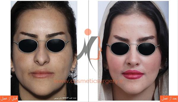 جراحی زیبایی بینی