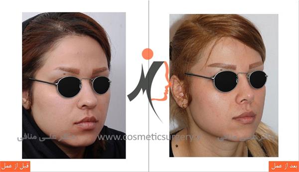 عمل جراحی زیبایی بینی گوشتی 2