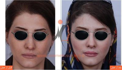 جراحی زیبایی بینی