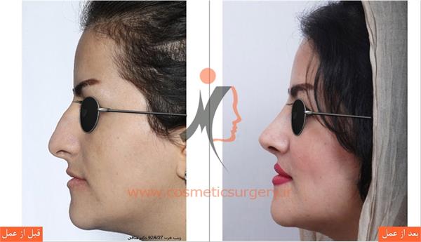 جراحی زیبایی بینی