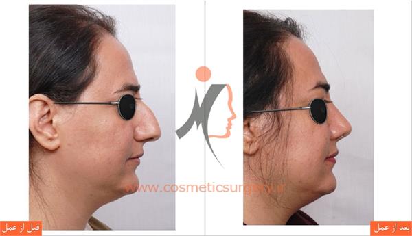 جراحی زیبایی بینی 2