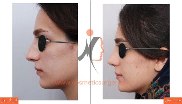 جراحی زیبایی بینی 2
