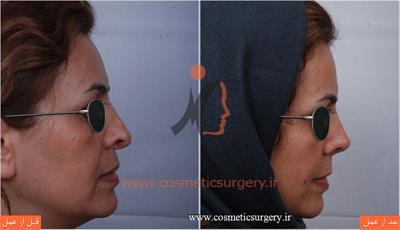 ترمیم بینی در بیماری که قبلا توسط جراحان دیگری عمل شده است