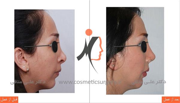 secondary rhinoplasty