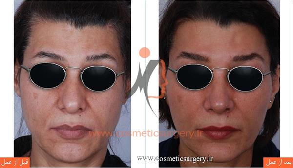 جراحی زیبایی بینی بهمراه لیفت صورت و تزریق چربی