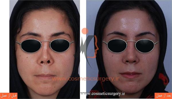 ترمیم بینی در بیماری که قبلا توسط جراحان دیگری عمل شده است