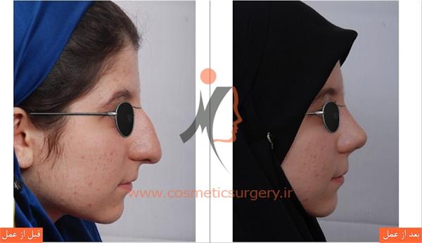 جراحی زیبایی بینی