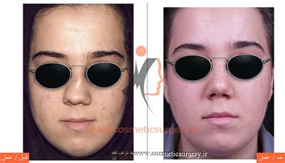 عمل جراحی انحراف بینی