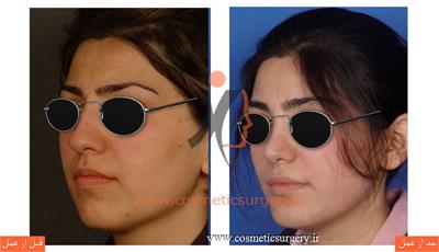 جراحی زیبایی بینی