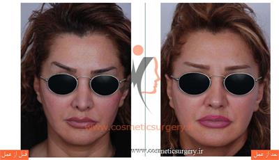 ترمیم بینی در بیماری که قبلا توسط جراحان دیگری عمل شده است