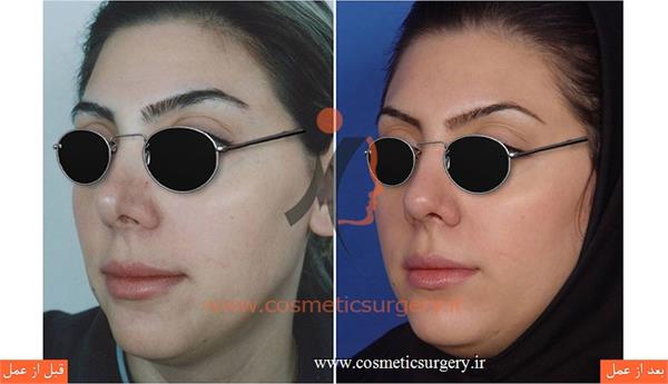 ترمیم بینی در بیماری که قبلا توسط جراحان دیگری عمل شده است