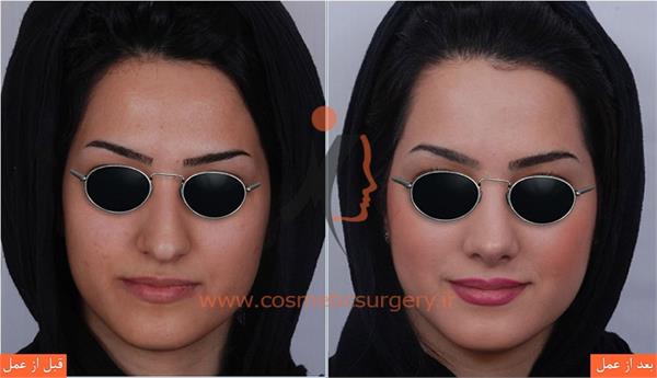 جراحی زیبایی بینی