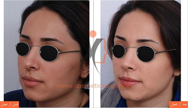 عمل جراحی انحراف بینی