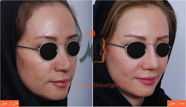 ترمیم بینی عمل شده توسط جراحان دیگر 2