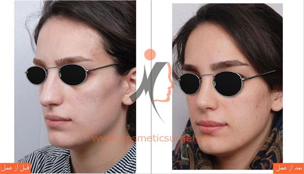 جراحی زیبایی بینی 1