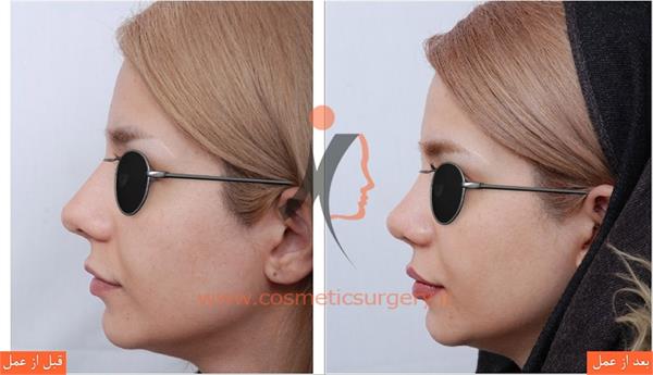 جراحی زیبایی بینی