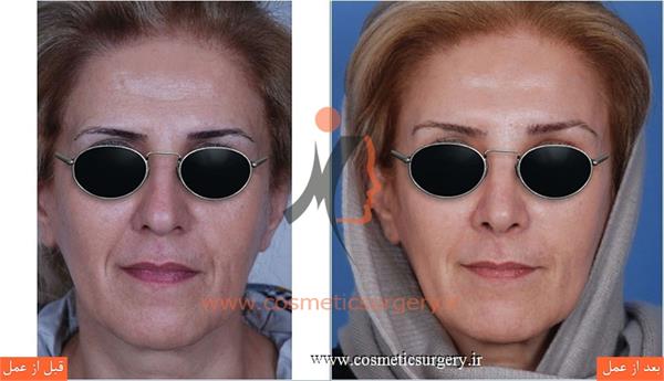 جراحی زیبایی بینی به همراه لیفت ابرو
