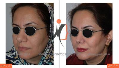 عمل جراحی زیبایی بینی 2