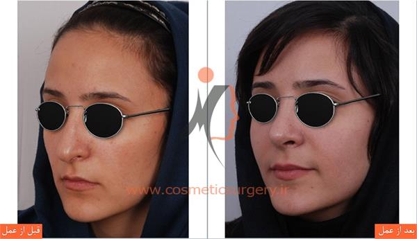 جراحی زیبایی بینی