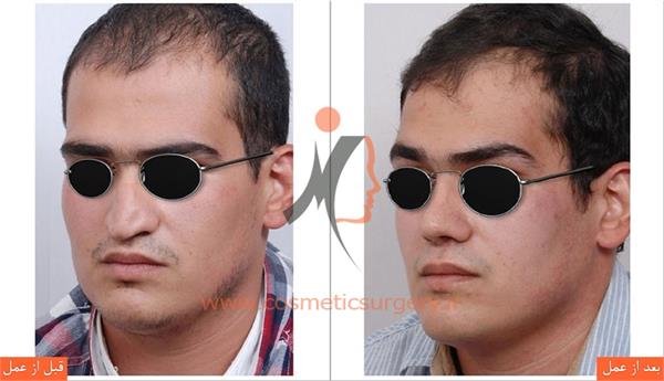 جراحی زیبایی بینی 1
