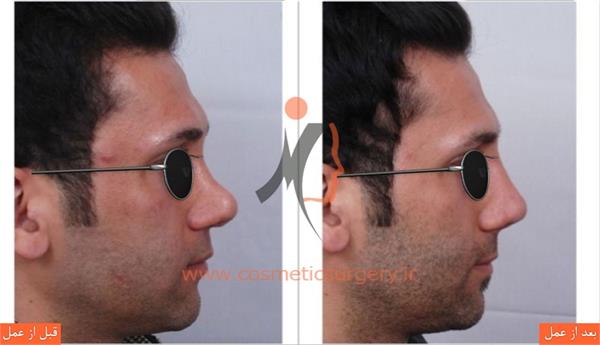 ترمیم بینی در بیماری که قبلا توسط جراحان دیگری عمل شده است