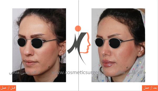nouse cosmetic surgery 4
