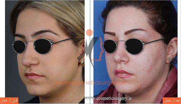 جراحی زیبایی بینی