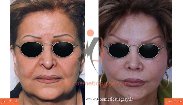 ترمیم بینی عمل شده توسط جراحان دیگر به همراه لیفت صورت و گردن ثانویه و تزریق چربی (صورت و گردن بیمار یک بار توسط جراح دیگر لیفت شده است)