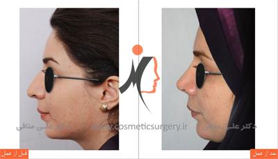 nouse cosmetic surgery 15