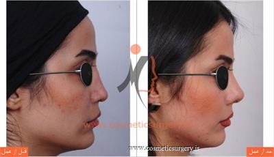 ترمیم بینی عمل شده توسط جراحان دیگر با استفاده از پیوند غضروف دنده