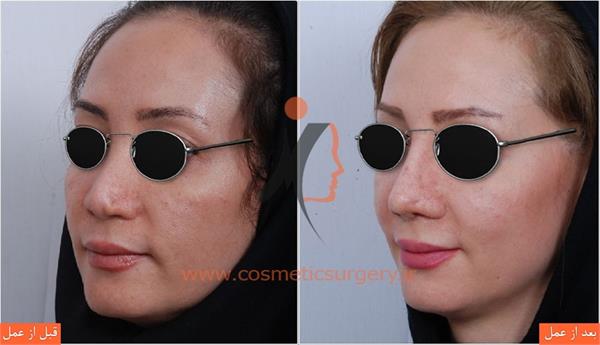 ترمیم بینی عمل شده توسط جراحان دیگر 1