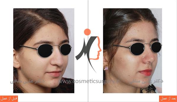 عمل جراحی انحراف بینی 2