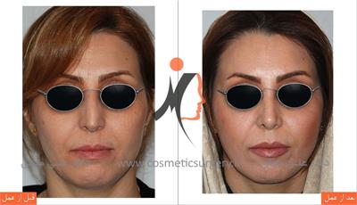 Rhinoplasty 2