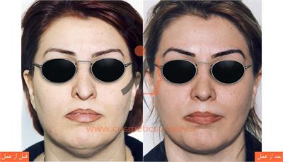 جراحی زیبایی بینی