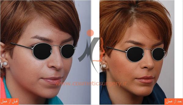 جراحی زیبایی بینی و جراحی چانه